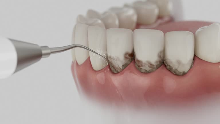 Trusted Dental Crowns And Bridges service in Derwood, MD - Dentist Open Now